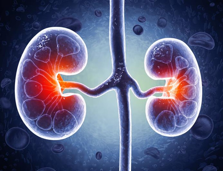 Causes of prevalent kidney failures and solutions