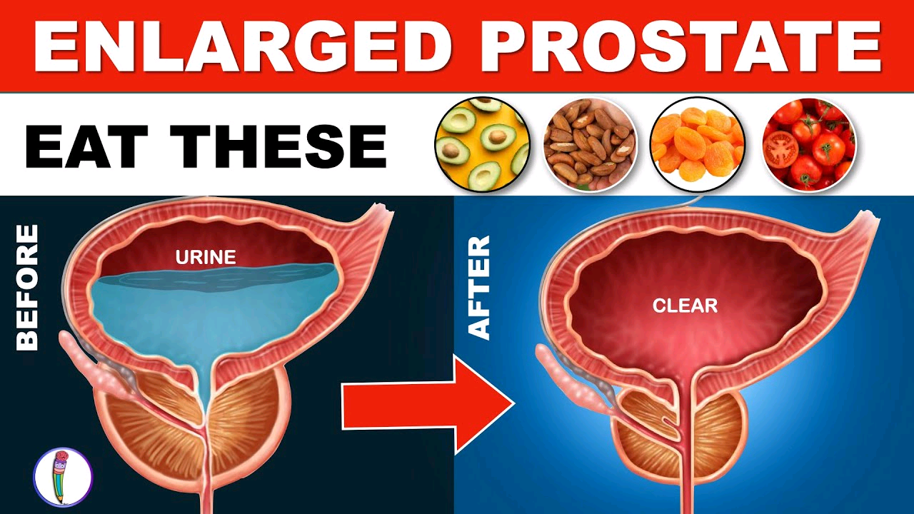 Prostrate enlargement